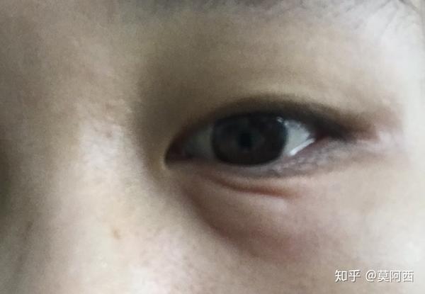 下眼袋突然肿起来是什么回事 下眼角突然肿了咋回事 趋势网络