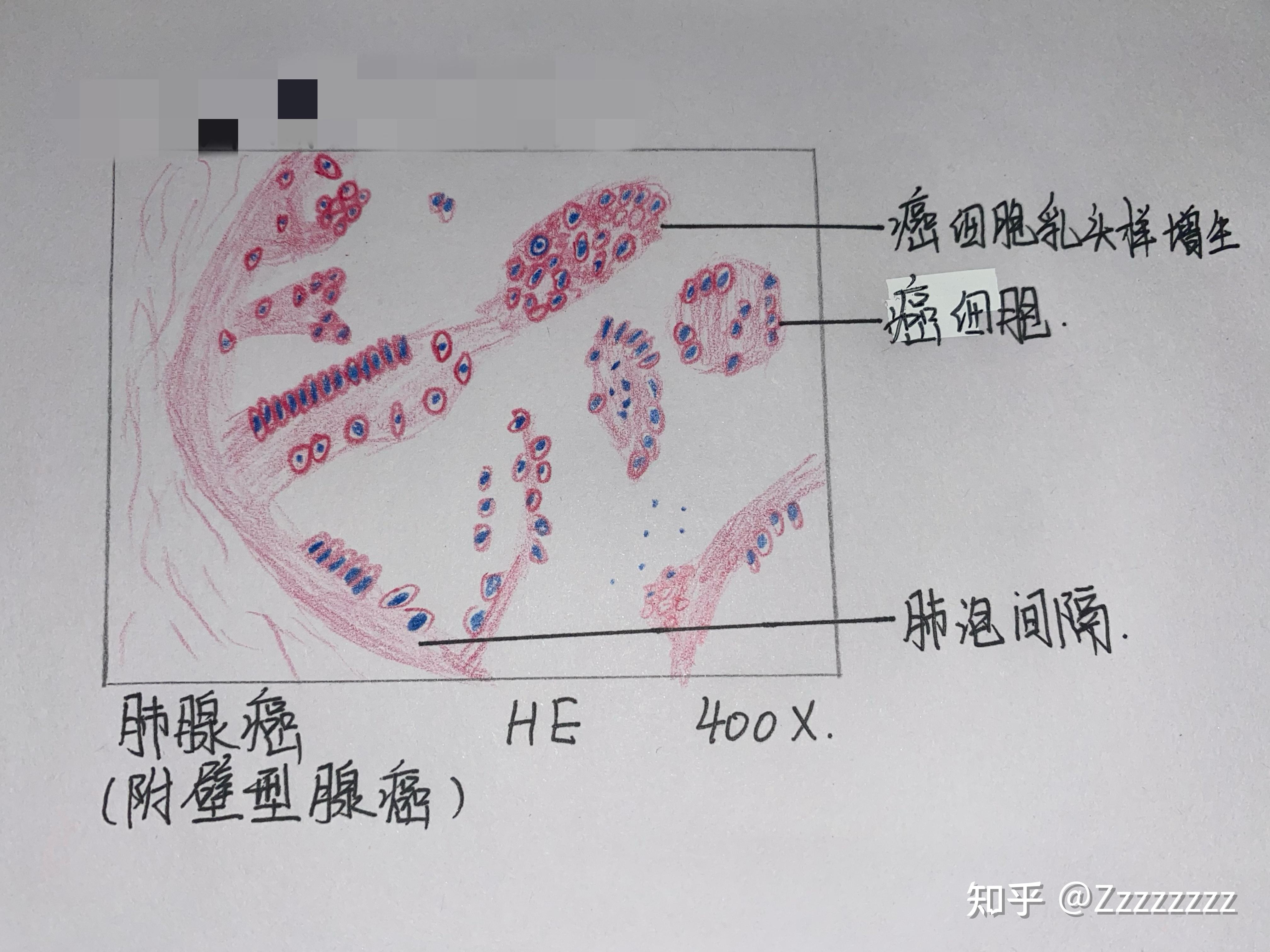 子宫平滑肌瘤红蓝铅笔图片