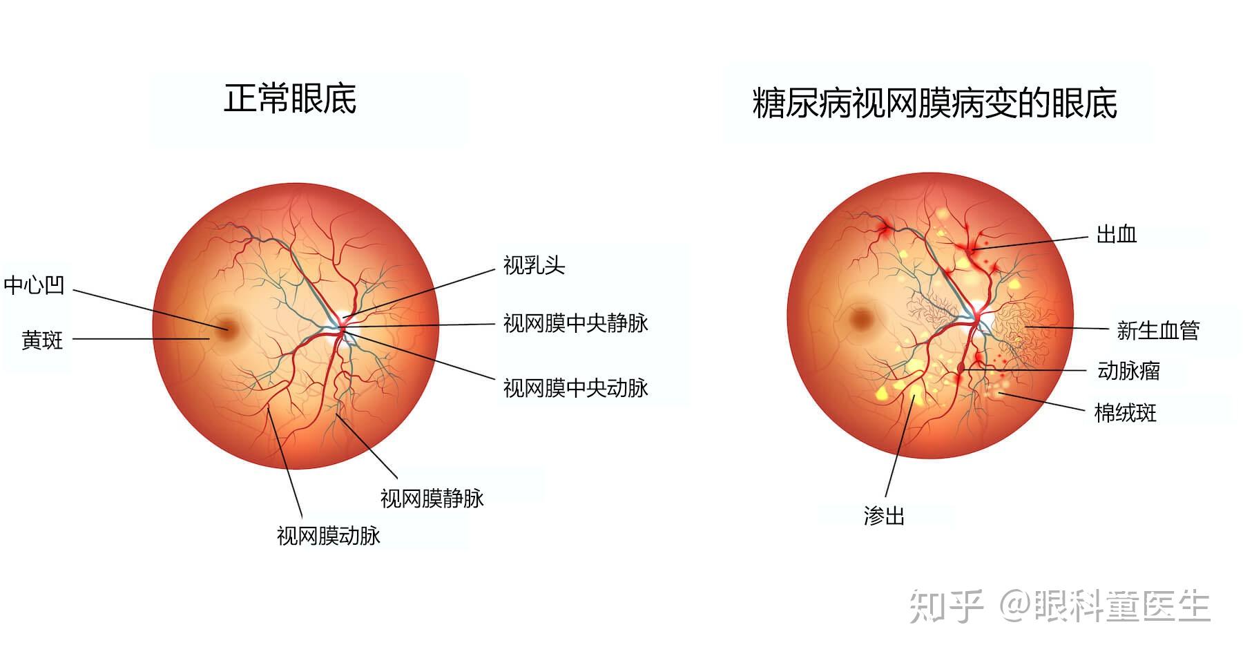 这是典型的糖网病眼底,里面可以看到很多视网膜的出血,渗出以及微血管