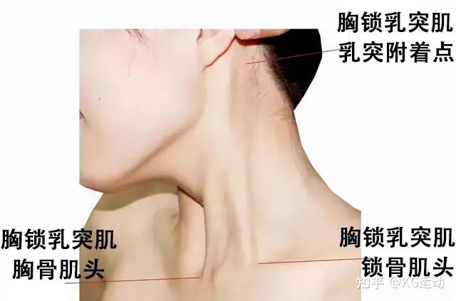 右侧胸锁乳突肌收缩图片