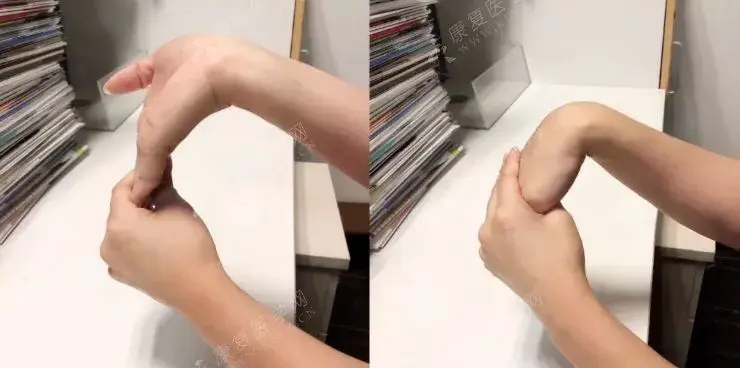 手腕疼痛活动受限6种方法应对节后腱鞘炎