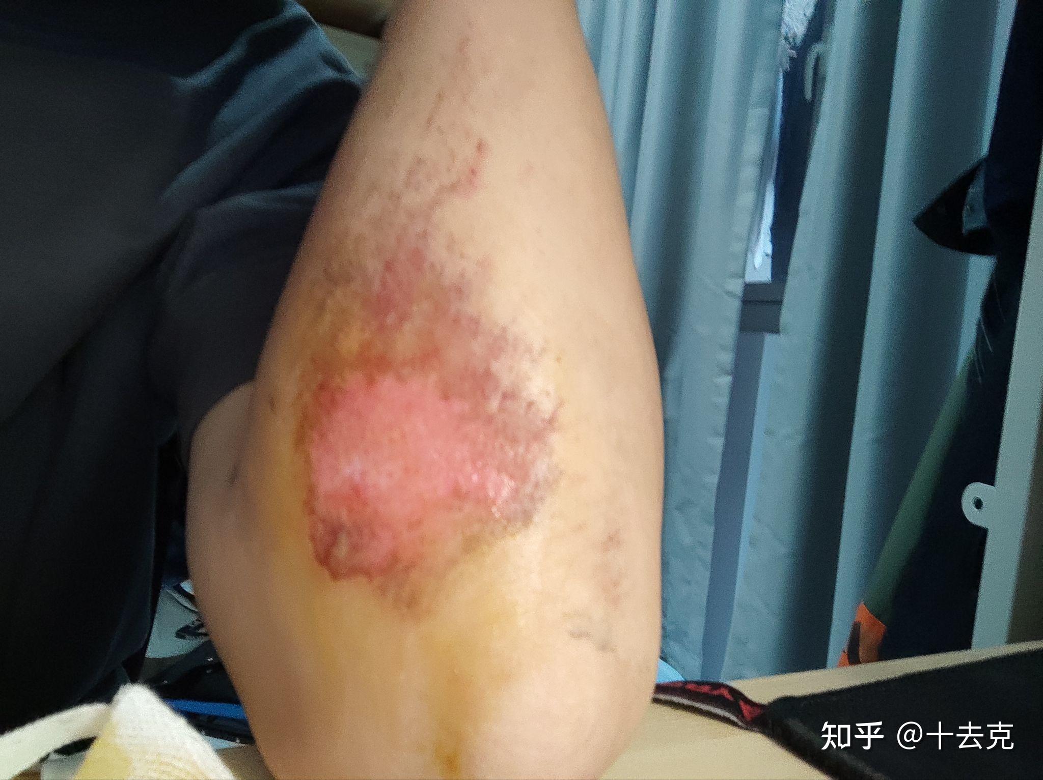 踢球摔倒擦伤记录&一年后2023年五一再一次摔伤的处理