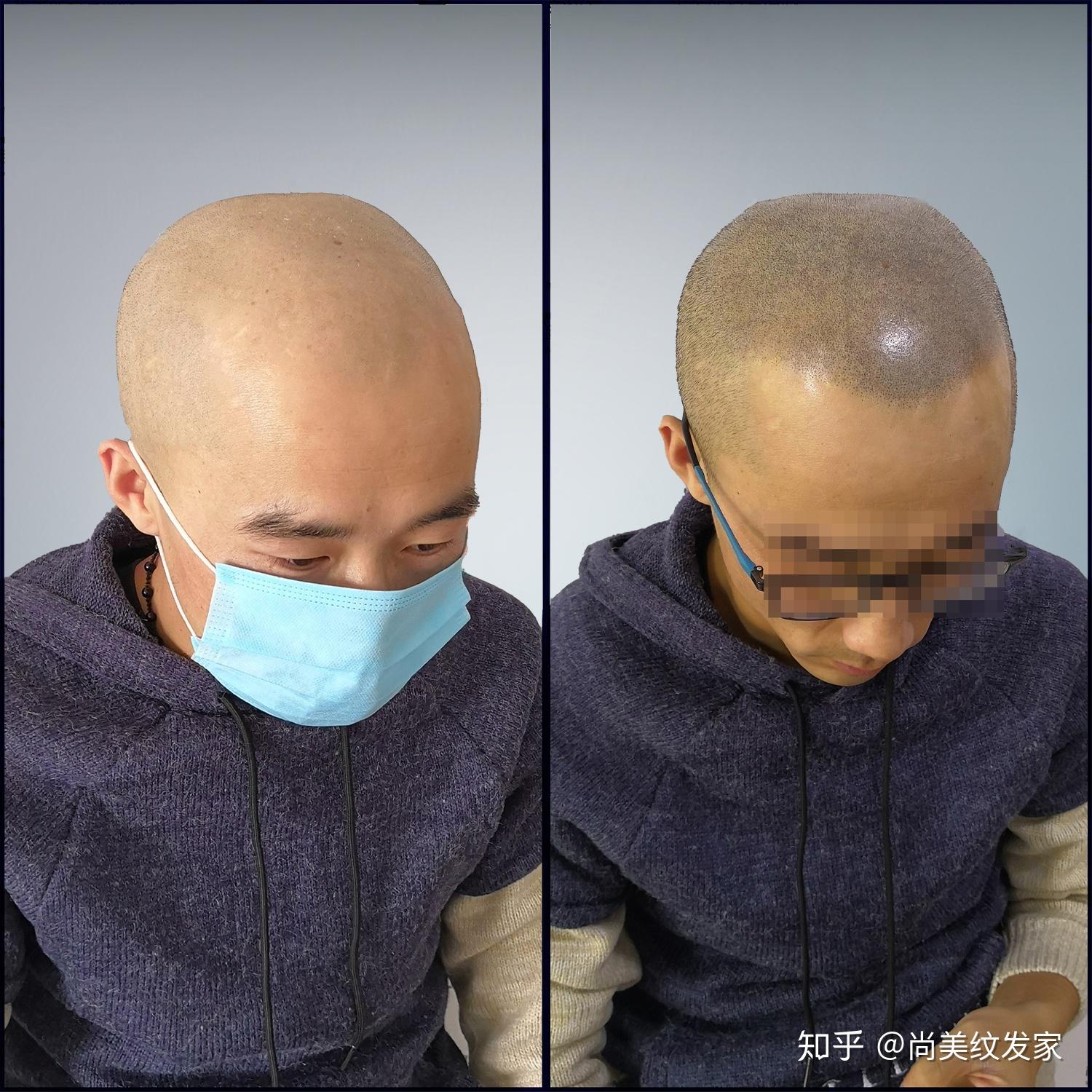 脱发的终结者,3D纹发头发纹上去 - 知乎