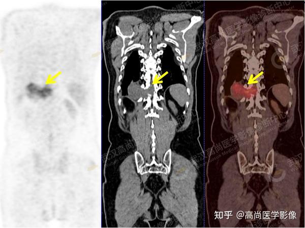 纵隔肿瘤PET/CT表现及应用价值【高尚医学影像】 - 知乎