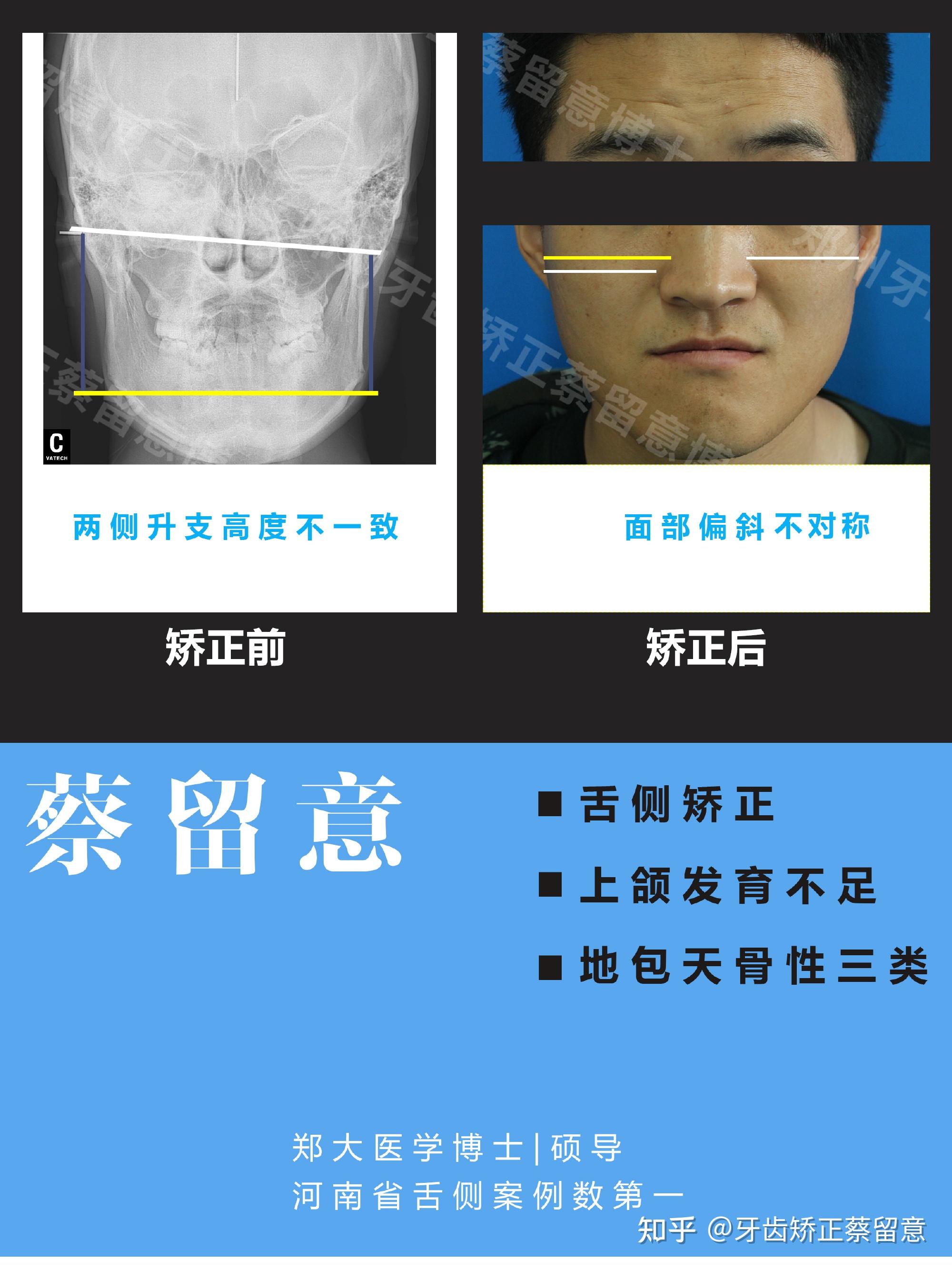 正颌手术矫正骨性地包天之下颌矢状劈开+鼻基底增高 - 知乎