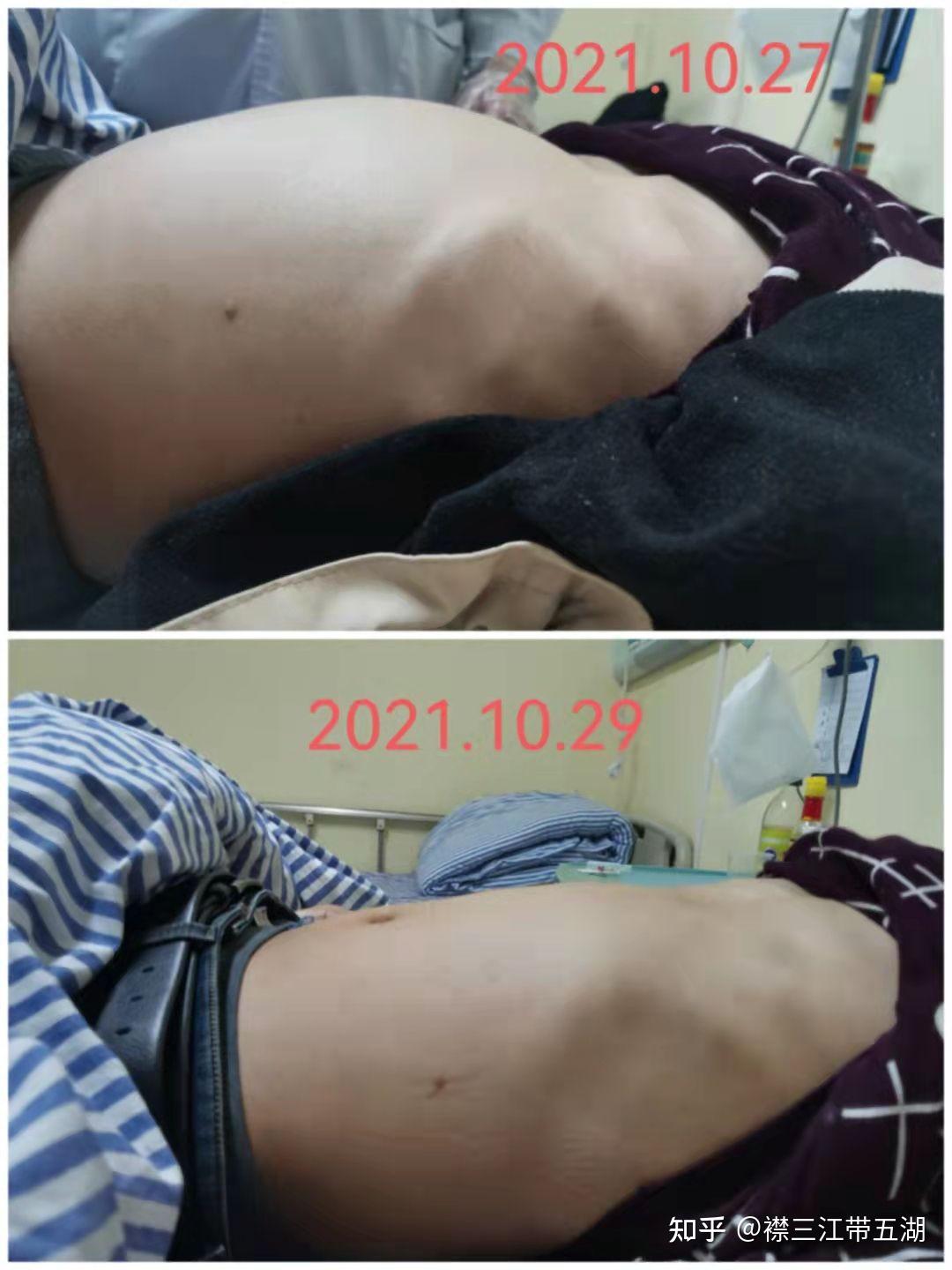 不完全性肠梗阻胃肠松动手法治疗