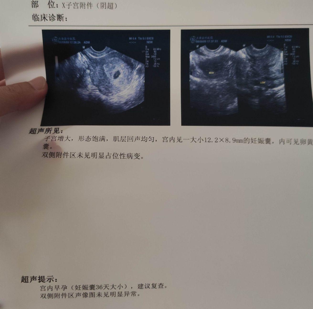 又过了五天,22号我再次来到医院,根据医生开的单,做了阴超(b超),血凝