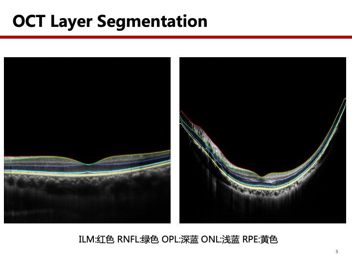 oct视网膜分层demo
