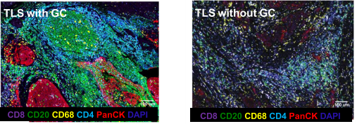 三级淋巴结构在肿瘤微环境中的作用 - 知乎