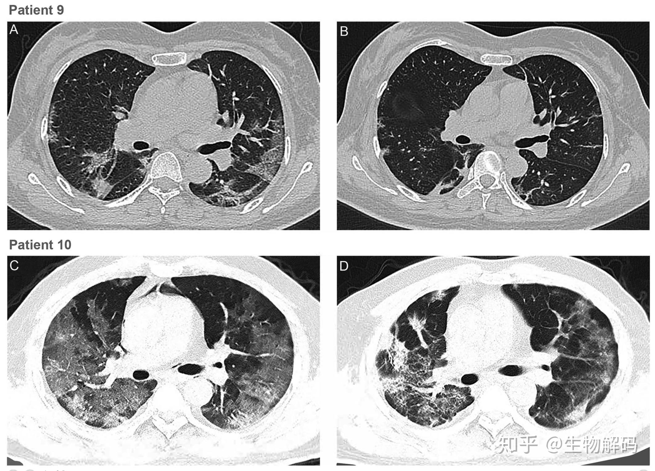 在这项工作中,作者探索了恢复性血浆(convalescent plasma)输血抢救