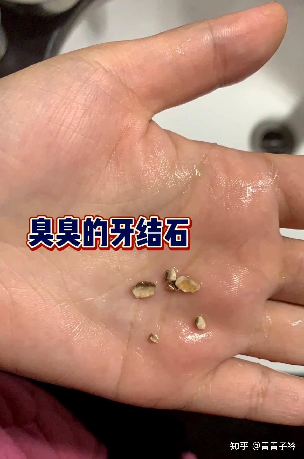 有牙结石的可以先去清理一下这个结石,就是图上那种脏脏臭臭的哈,你不