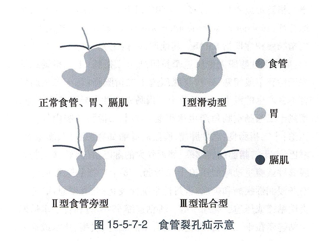 食管裂孔疝的分型 - 知乎
