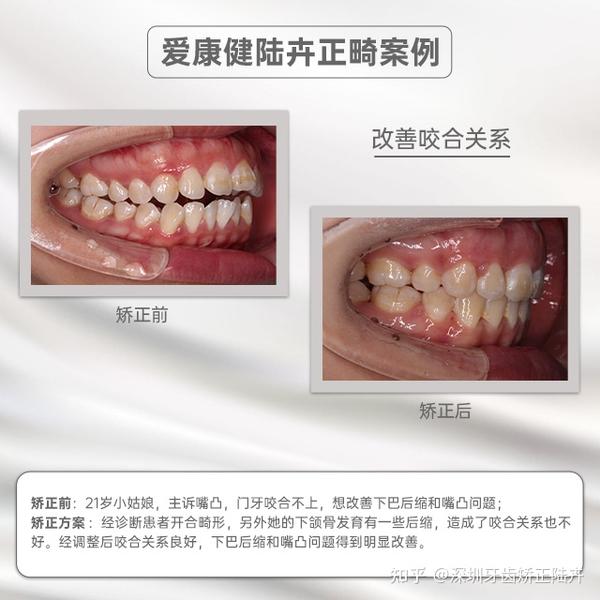 深圳牙齿矫正(正畸)|门牙合不上是什么原因? - 知乎