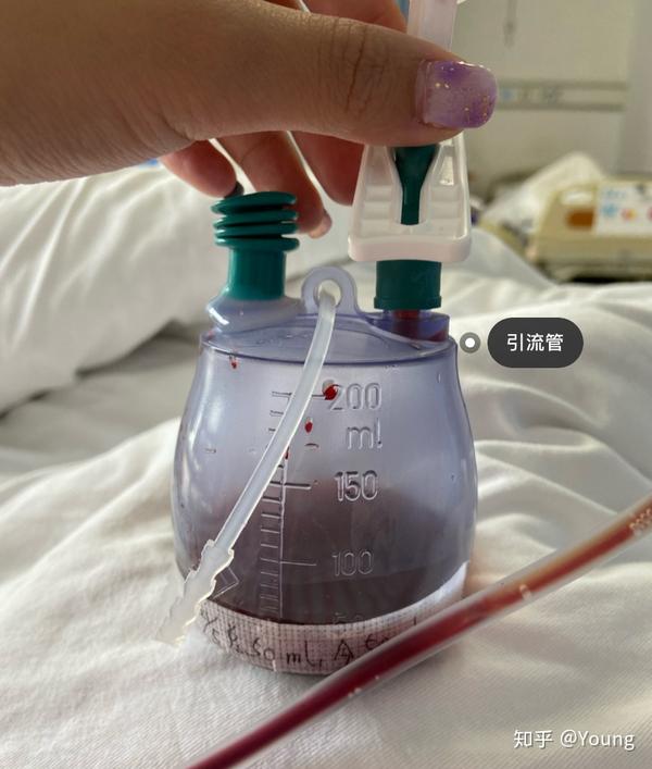 24岁甲亢7年甲状腺全切手术