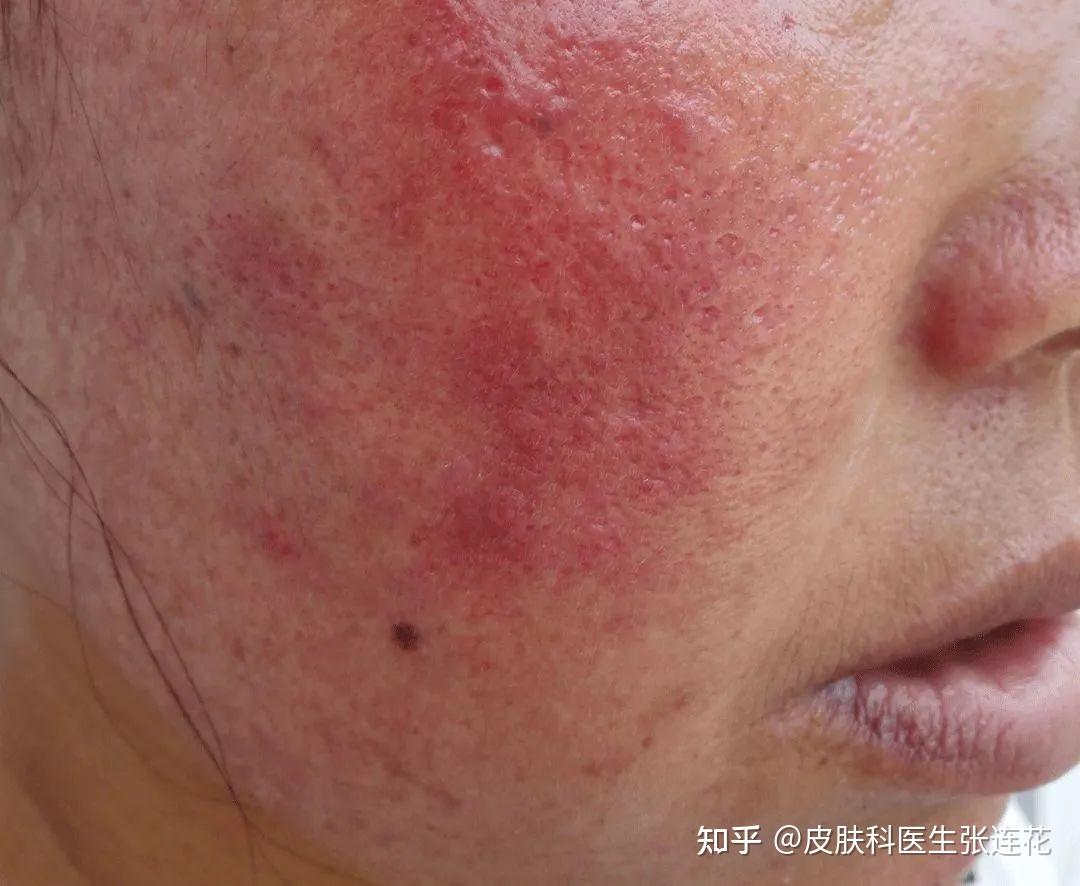 【赣州治疗皮炎医院】天呀!身上皮炎,罪魁