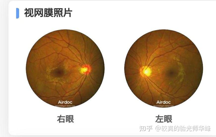 验光时查眼底时,眼底照相机提示有黄斑前膜,日常有哪些注意事项?