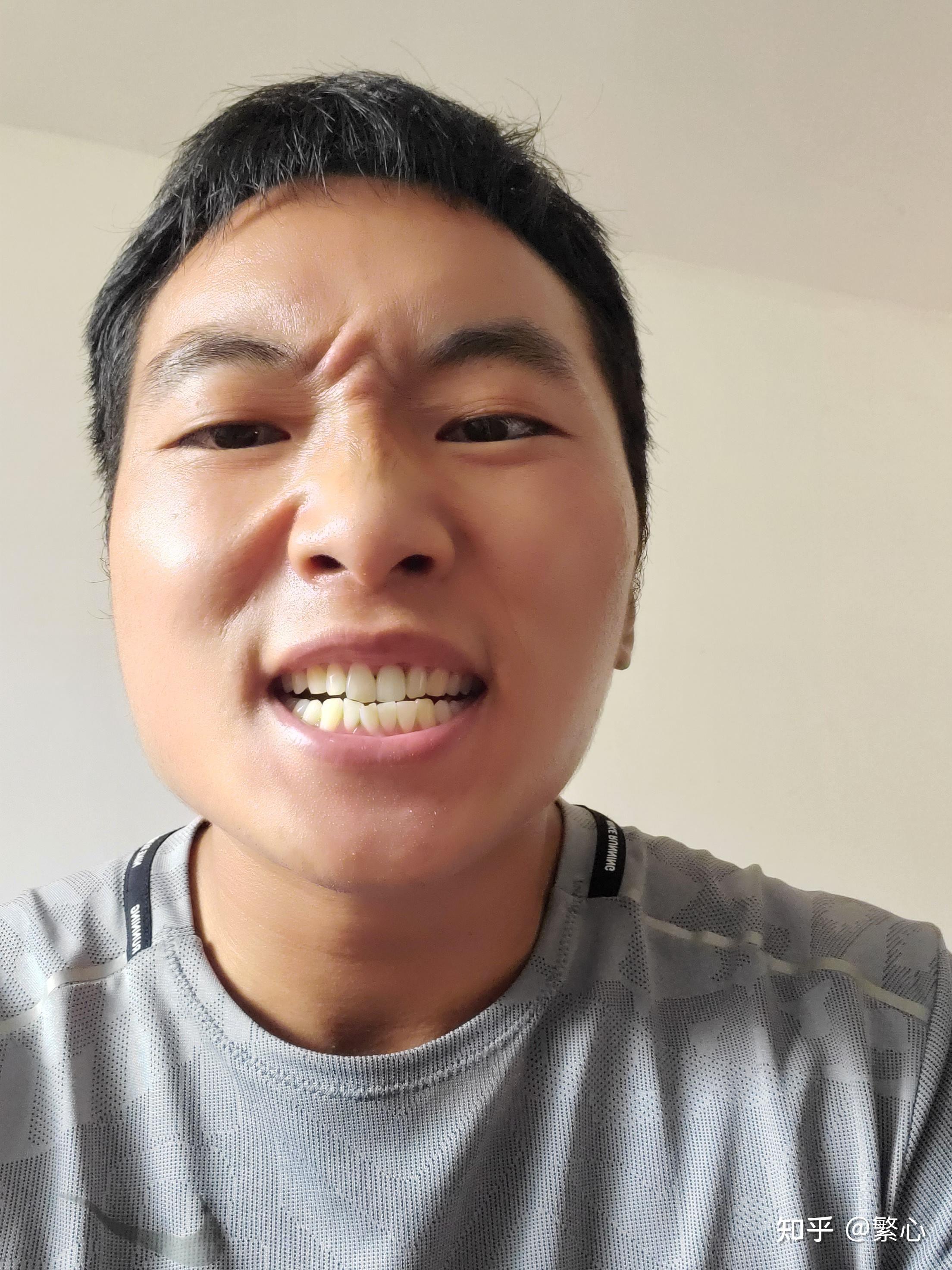 我的缺牙和种牙经历