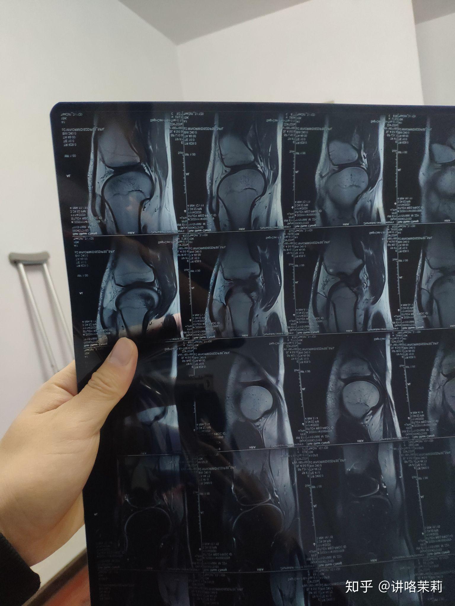 半月板后角变性怎么康复训练,目前不能下蹲,走路有点疼