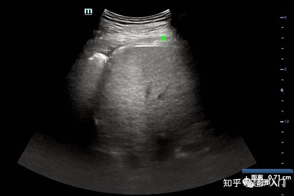 胸腔积液的超声诊断,既简单又复杂