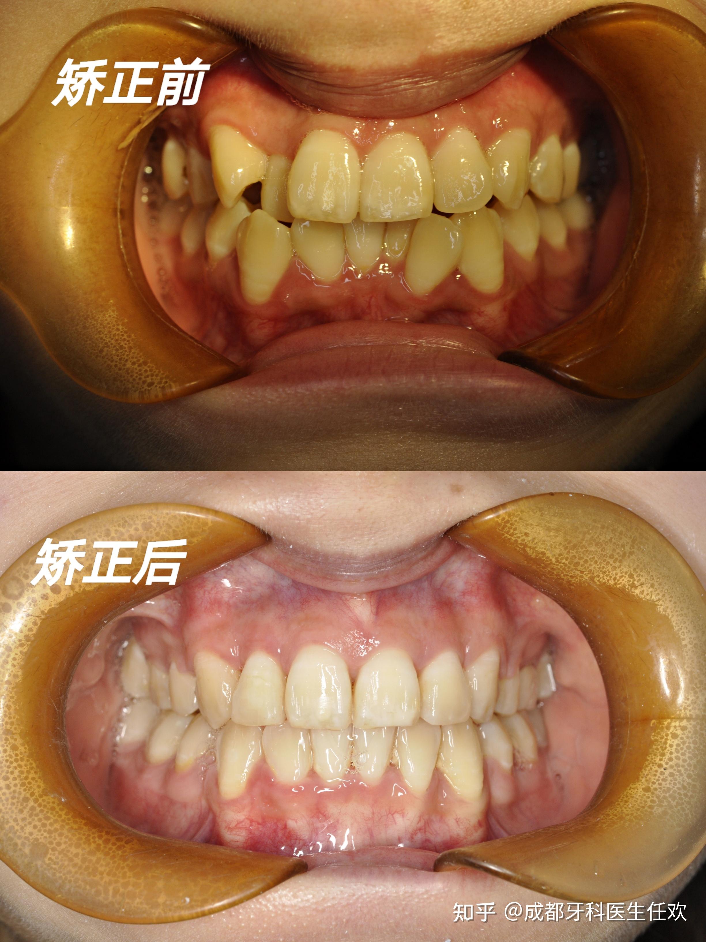 正畸正颌联合矫治案例