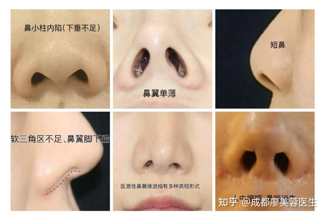 鼻翼缘退缩问题是如何出现的呢? - 知乎