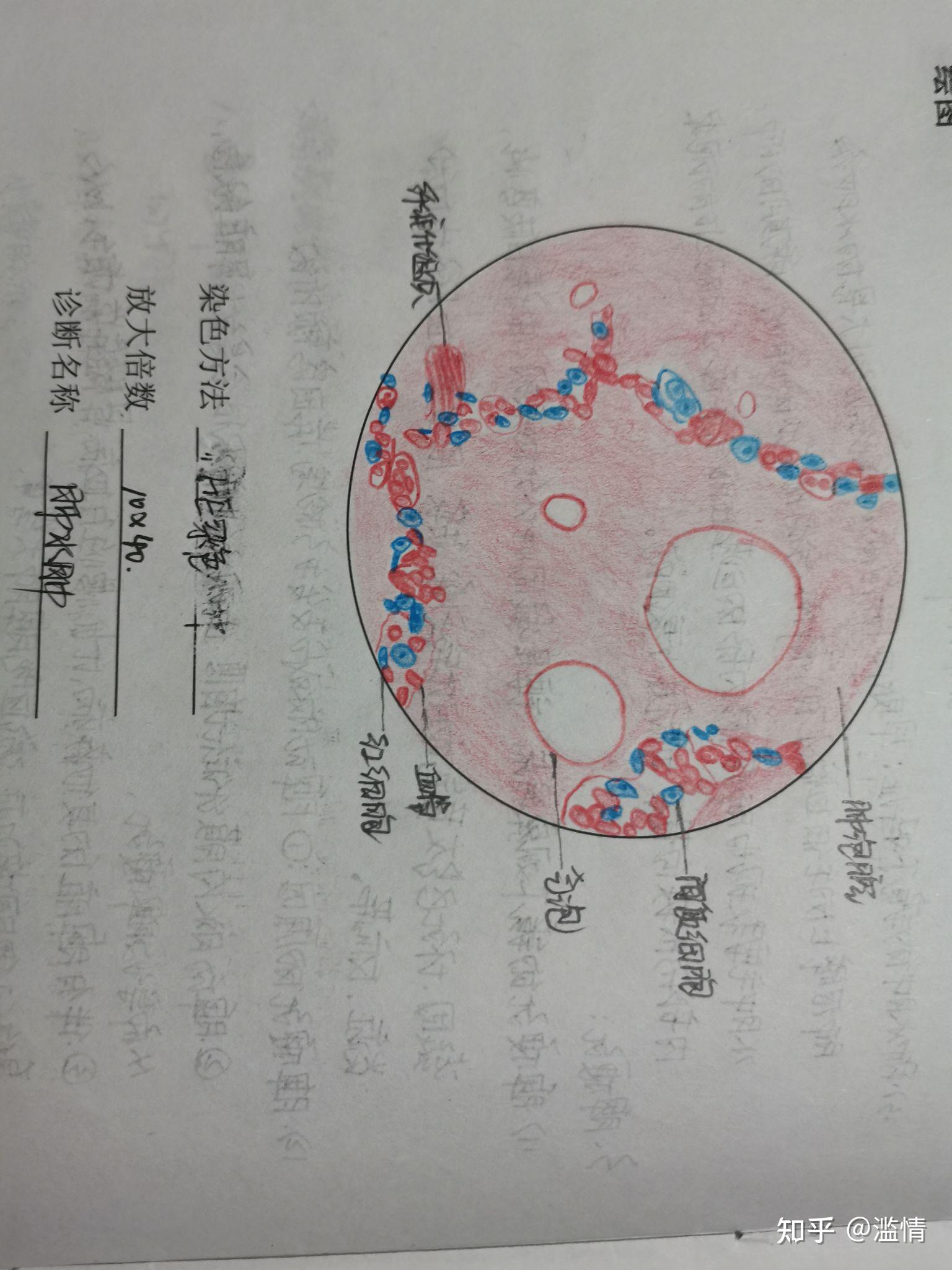 肺脓肿病理切片手绘图图片