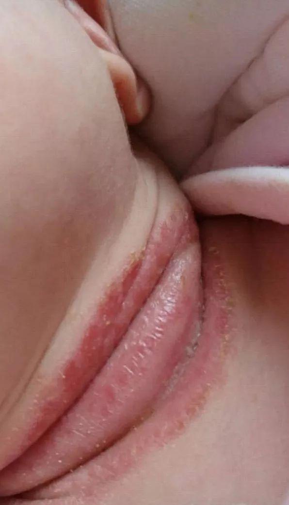 宝宝褶皱处淹红流脓发臭怎么办做好这两步就能好得快