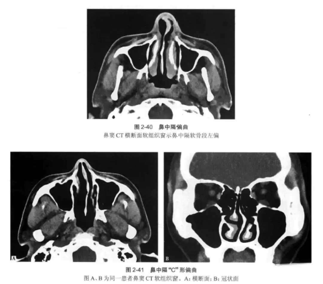 鼻腔,鼻窦正常解剖,解剖变异及影像学表现