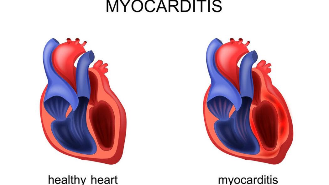 药剂师学习笔记之心肌炎、心包炎(Myocarditis/Pericarditis) - 知乎