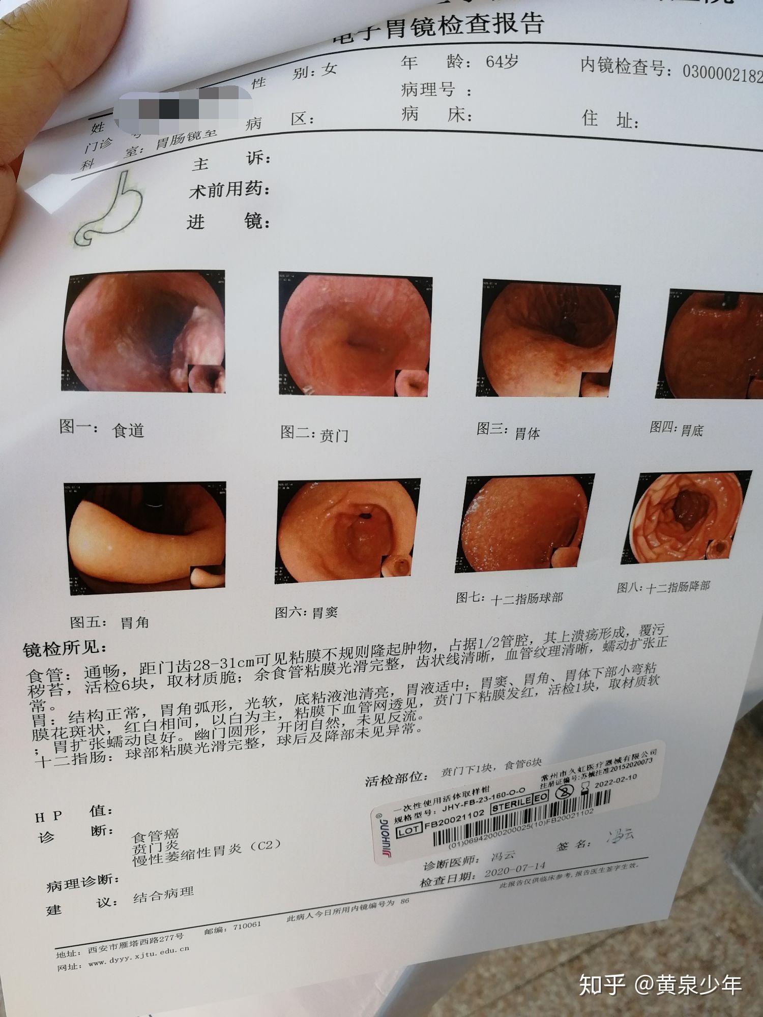 食道癌活检报告图片图片