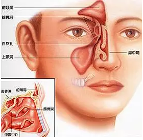 刚得鼻窦炎怎么办?有什么方法治疗或者药么?