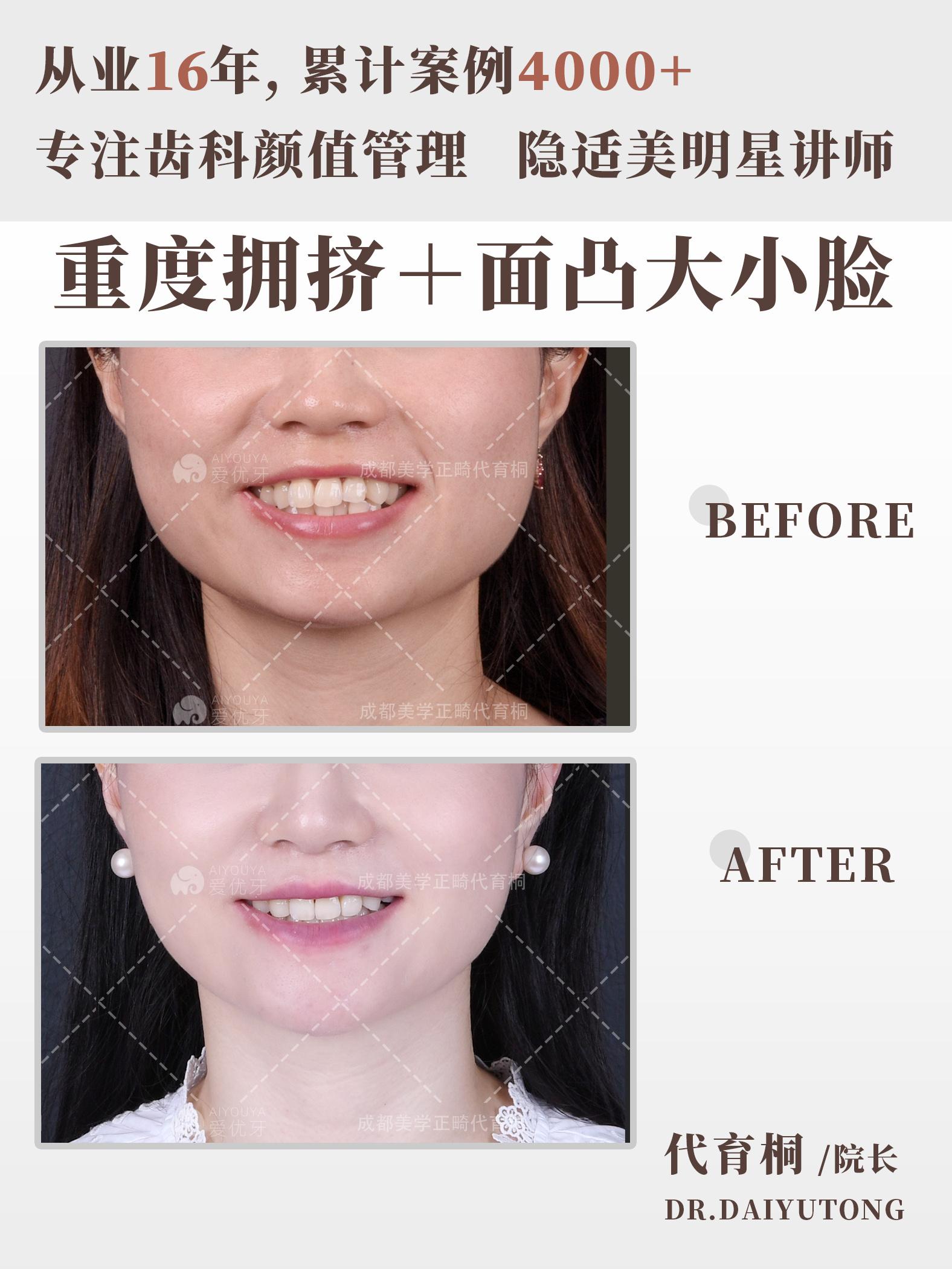 成都正畸|低角前突拔牙矫治,改善面凸大小脸 - 知乎