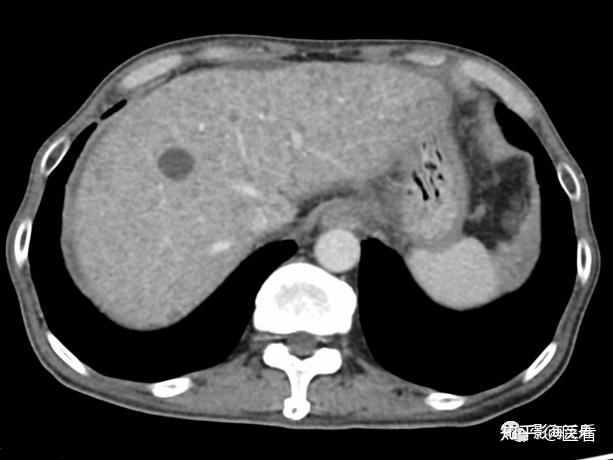 肝脏弥漫性病变的诊断 - 知乎