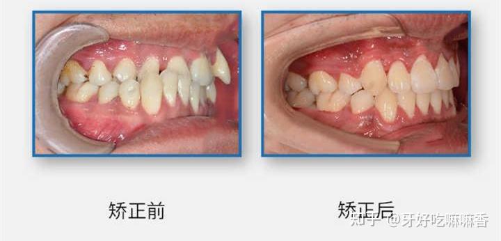 骨开裂和骨开窗图片图片