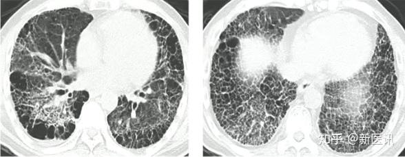 间质性肺炎影像学图片图片