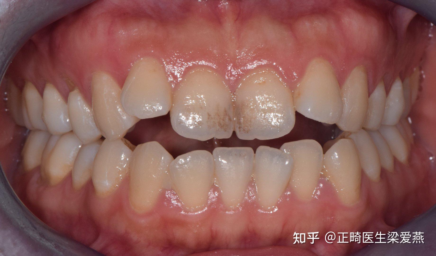记录我在上海正畸矫正牙整牙的过程 - 知乎