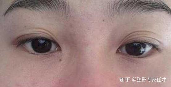 全世界的人都想做双眼皮,我却发愁我的多层双眼皮