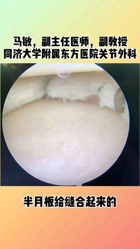 膝关节游离体病例分享二