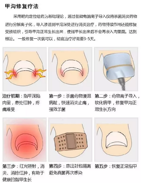 宝宝甲沟炎怎么处理图片