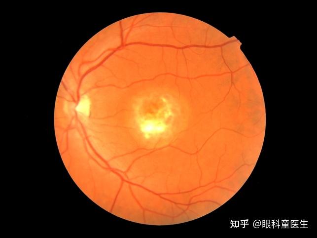 视网膜变性疾病——7、卵黄样黄斑营养不良 - 知乎