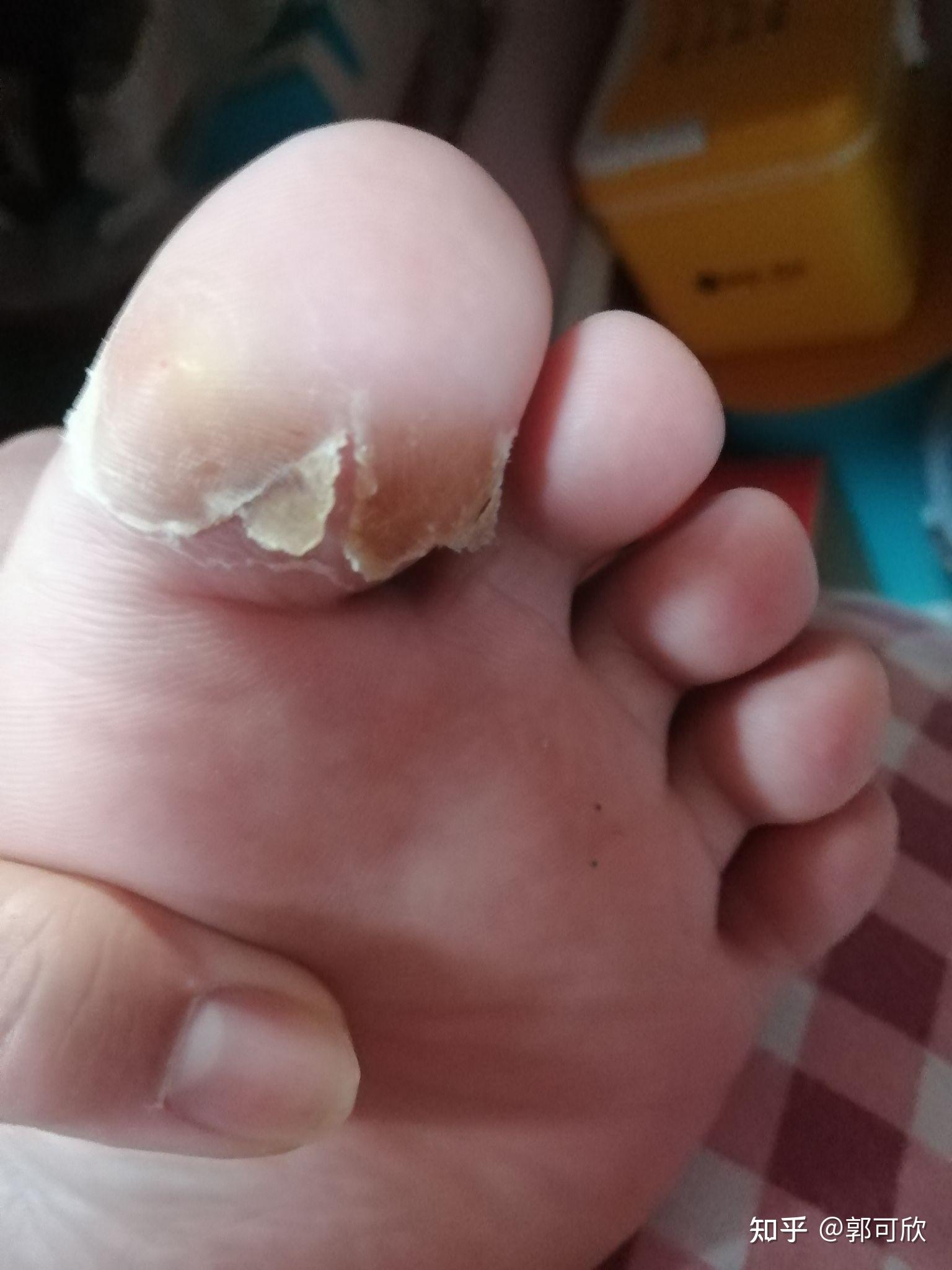 液氮冷冻鸡眼治疗贴. - 知乎