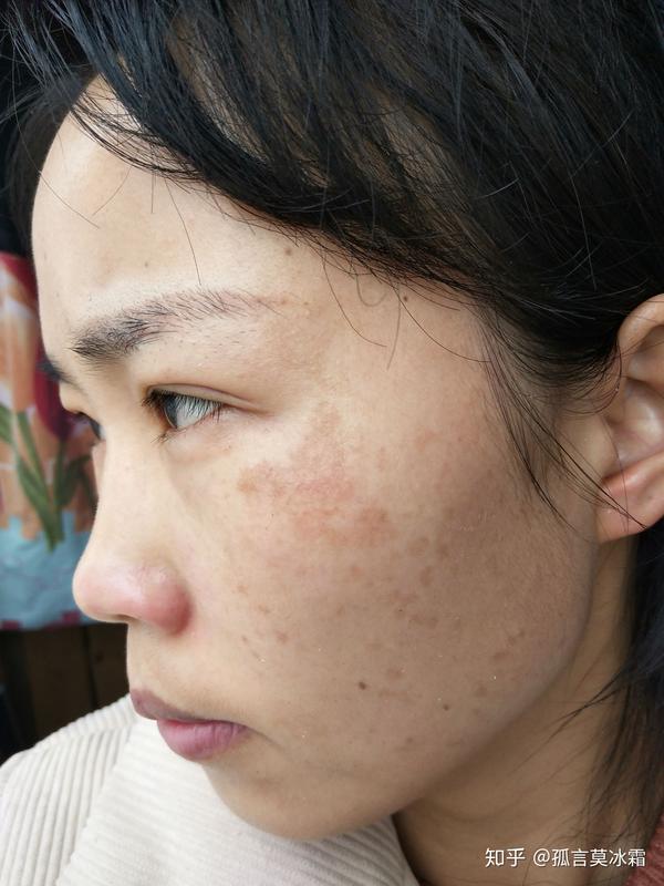 氨甲环酸注射液湿敷祛除雀斑淡化黄褐斑超强解读