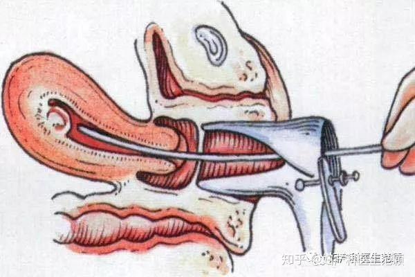 人流后宫颈图片图片