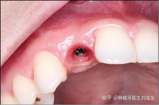 瑞士iti  straumann03 骨水平种植体系列    灵活的种植体系列,经验