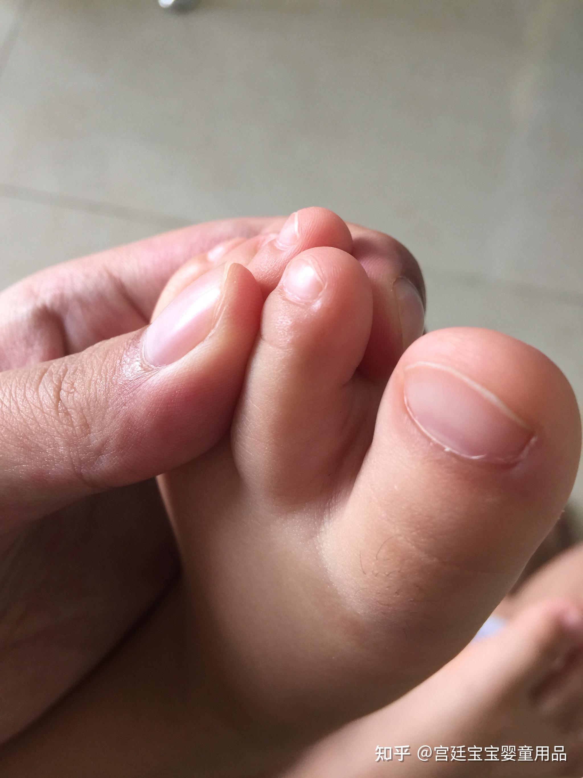 怎么判断宝宝是脚气图片