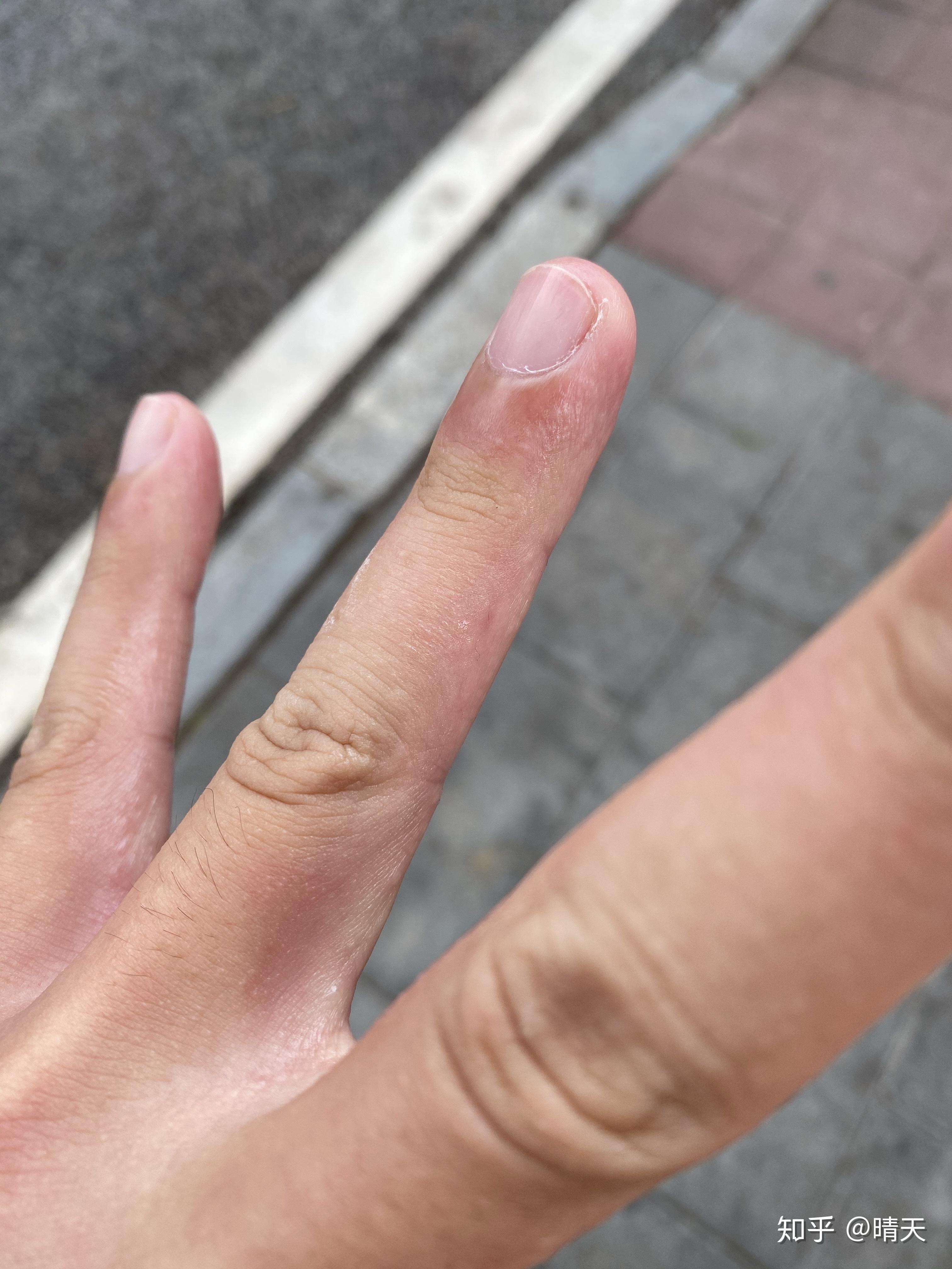 手指上长小痘痘指腹长小水泡