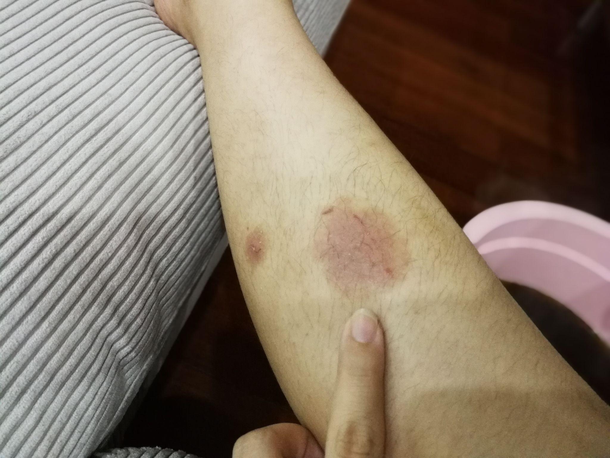 我是一名慢性湿疹患者此文章创建的意义在于鼓励其他身患湿疹的人一起