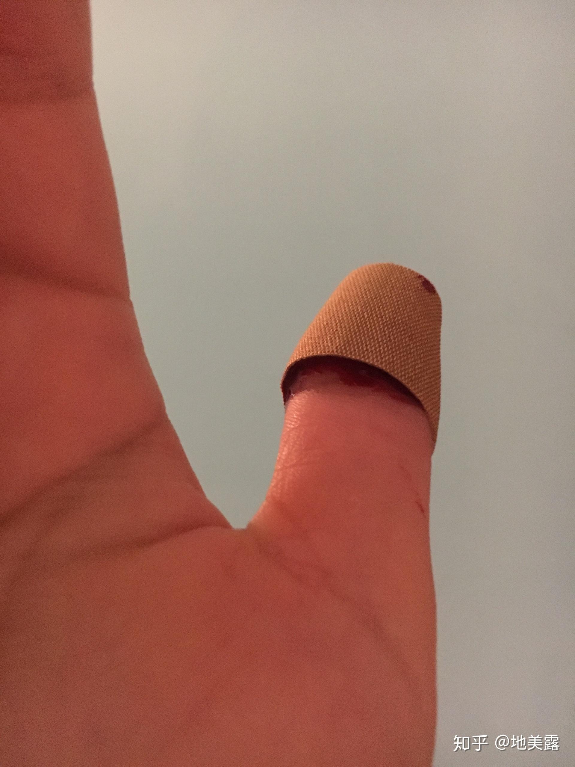 我把手上的寻常疣挖掉了