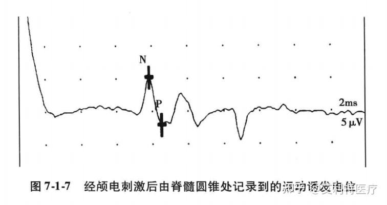 经颅电刺激运动诱发电位的相关研究 - 知乎