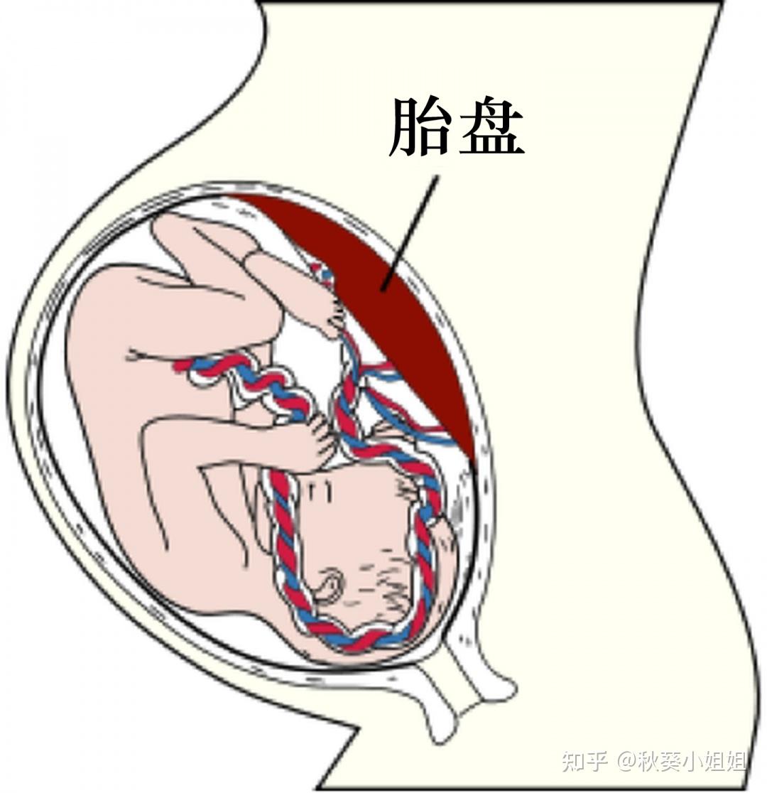 明明白白做超声(十七)：胎盘异常的超声显像检查之二——前置胎盘 - 知乎